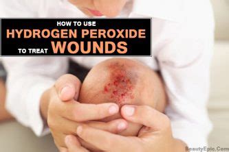 How To Treat Wounds With Hydrogen Peroxide?