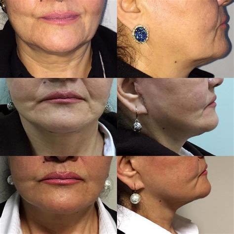 Platysmaplasty Before And After Photos » Facelift: Info, Prices, Photos ...