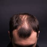 GFC Hair Loss Treatment in Bangalore | Bodycraft