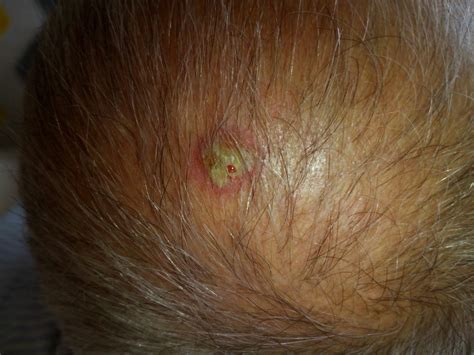 White Bumps On Head Scalp