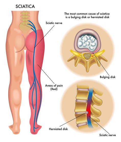 Sciatica: causes and treatment - ENG Eme Physio