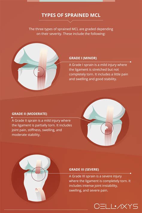 What Is The Sprained MCL Recovery Time? - Cellaxys