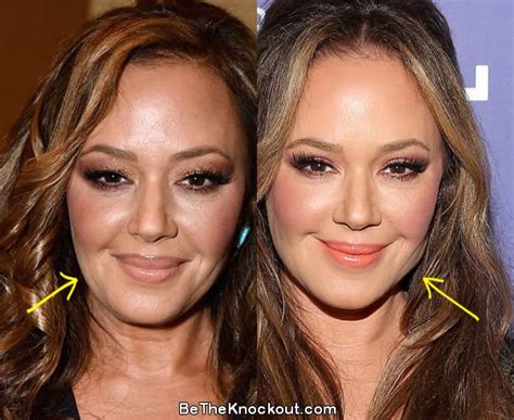 Leah Remini Botox