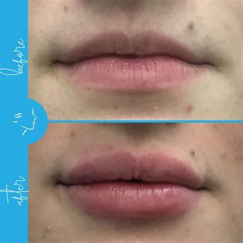 Lip Filler Lewisburg | Lip Augmentation in Central PA