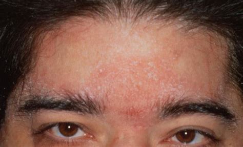 Seborrheic Dermatitis On Eyelids