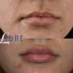 Lip Filler Before and After Pictures | Book Appointment