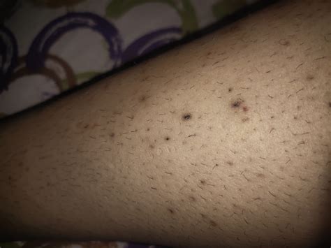 Can someone please help me how we can I treat these ingrown hair problems and these marks on ...