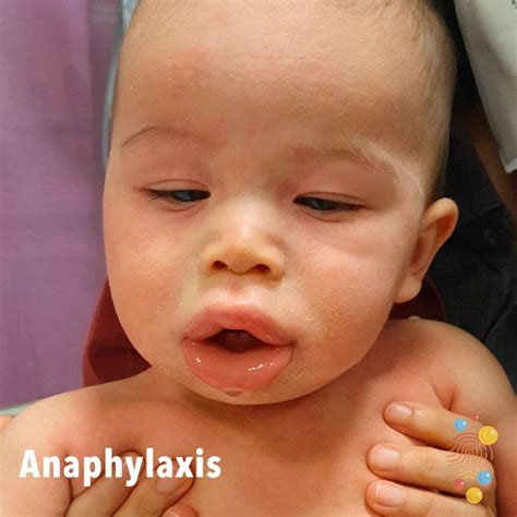 Anaphylaxis - Skin Deep