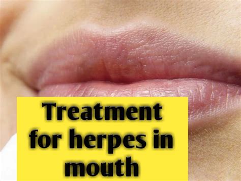 Treatment for herpes in mouth