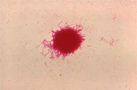 Haemophilus Ducreyi Gram Stain