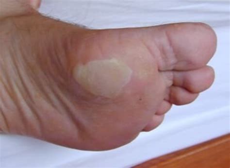 What Causes Blood Blisters On Toes - Printable Templates Protal