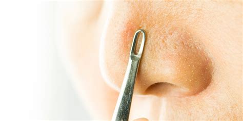 Blackhead Removal Hacks: Dermatologists Say Yay or Nay to 5 DIY Options | SELF