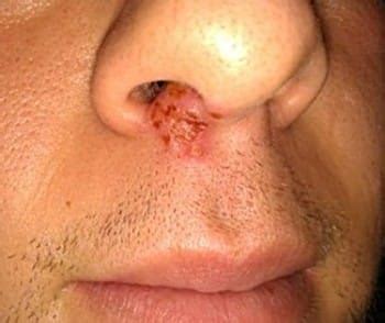 How to Treat Cold Sores Under Nose From Blowing Nose - Cold Sores Cured