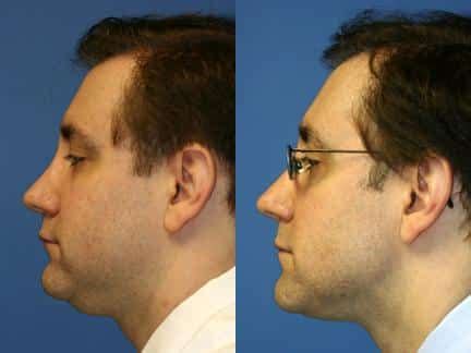 Neck fat removal in New York - Philip Miller MD