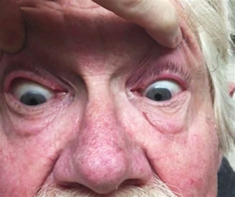 Opsoclonus-Myoclonus Syndrome In 71-Year-Old Patient