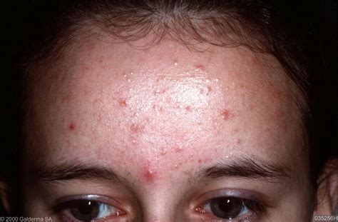 Skin Picking Disorder; Dermatillomania - Wellbeing Center, Middle East