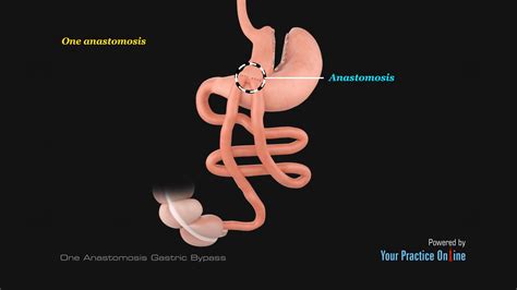 One Anastomosis Gastric Bypass Video | Medical Video Library