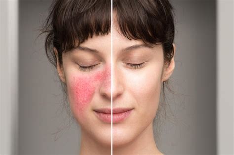 Premium Photo | Signs and symptoms of rosacea natural cures in the treatment of skin disorders