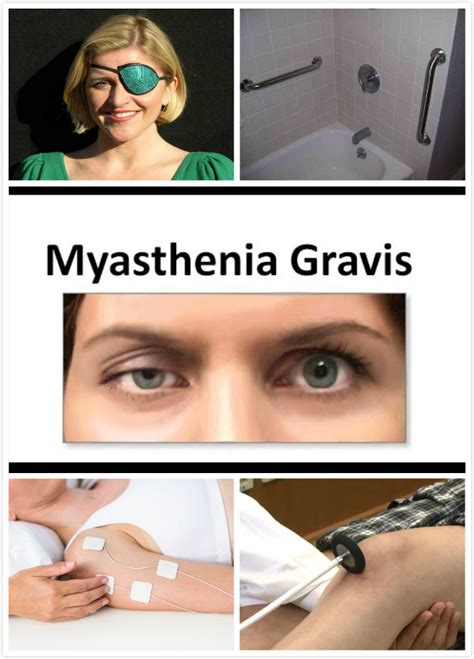 Myasthenia Gravis Diagnosis | New Health Advisor