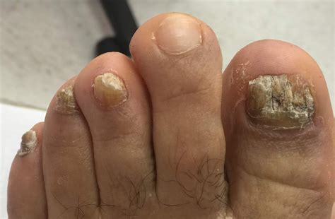 Toenail Fungus Before And After