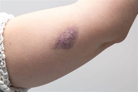 What the Color of Your Bruise Is Trying to Tell You | Reader's Digest