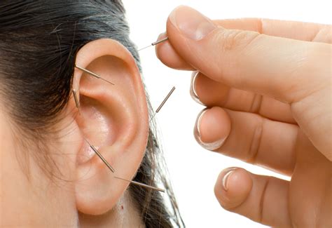 Acupuncture… for the ears? - DiscoverHealth