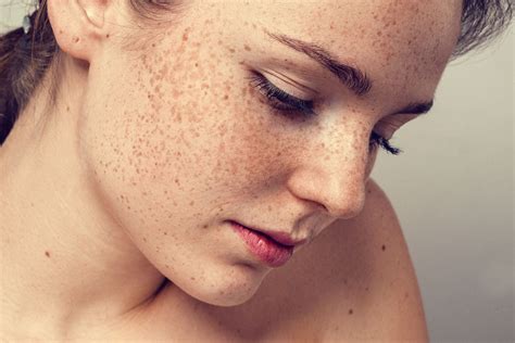 Freckles On Face Remove at Home:Skin Care Top News