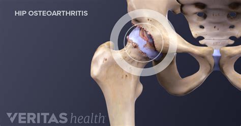 What Is Hip Osteoarthritis?