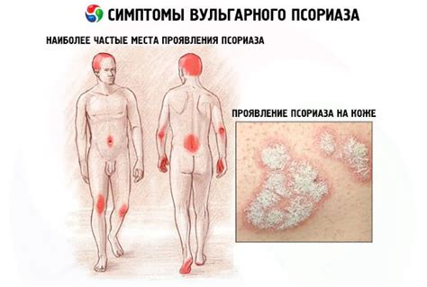 Vulgar psoriasis: causes, symptoms, diagnosis, treatment