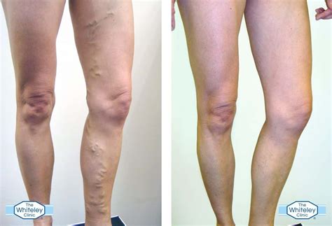 Identifying Varicose Veins