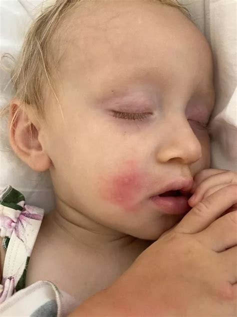 Mum says hotel room 'crawling' with bed bugs left family covered in bites - Wales Online