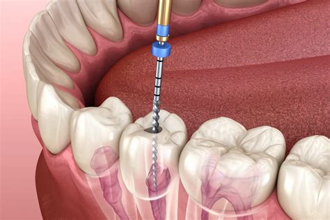 The Complete Guide to Dental Root Canal Treatment: Procedure, Benefits, and Aftercare - larepera.net