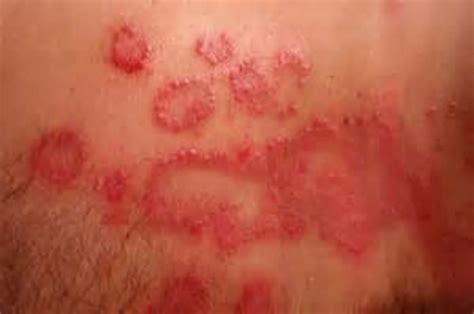 Do Yeast Infections Cause You To Be Dry at Stephen Modlin blog