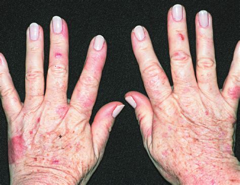 Porphyria cutanea tarda – Bullae and ulcerated lesions topped by crusts ...