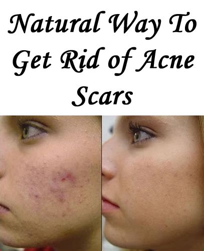 How To Get Rid Of Acne Scars Naturally