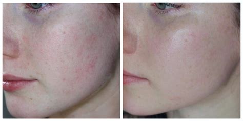 before and after 1 - Love My Skin