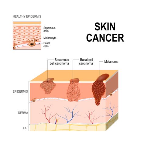 What Are The Best Essential Oils and Recipes for Skin Cancer? | Essential Oil Benefits