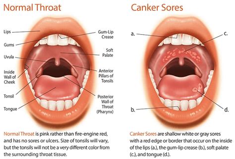 Best Canker Sore Treatment In India | Mouth Sore Cure Near Me