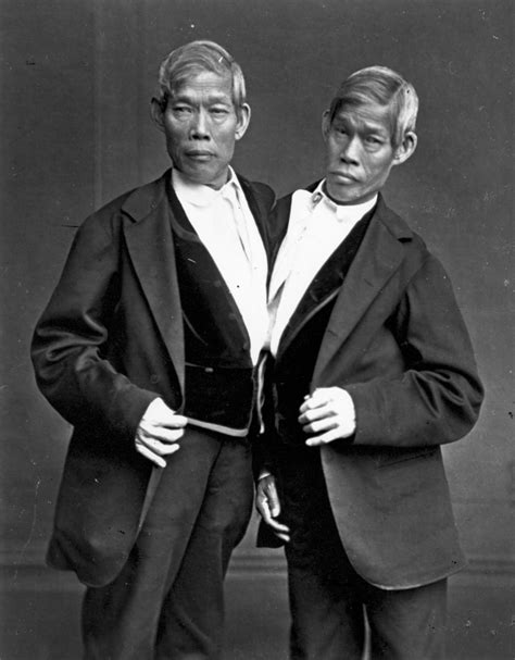 siamese twins - Google Search | Freak show, Human oddities, Conjoined twins