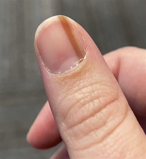 Subungual Melanoma: Tan Streak On Woman's Nail Was Skin Cancer