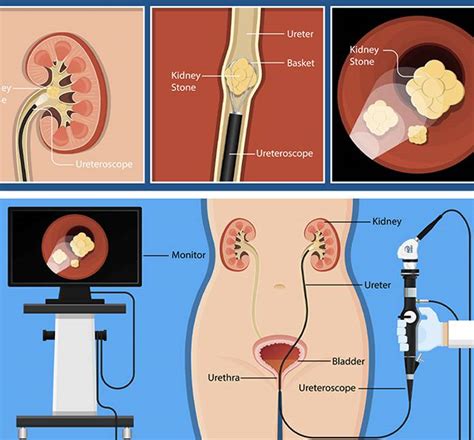 Kidney Stone Removal - psc.gov.ls