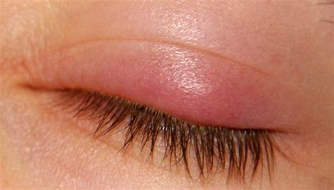 upper eyelid swelling Cheaper Than Retail Price> Buy Clothing ...