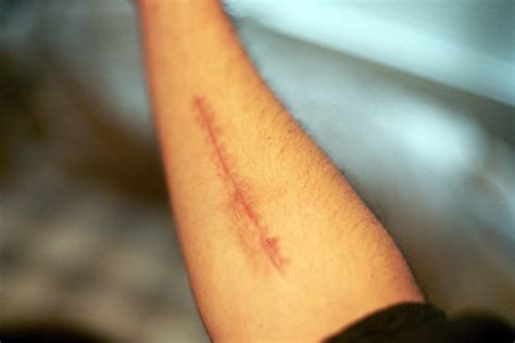 Scar - broken, bruised, forgotten, sore | Very broken arm...… | Flickr