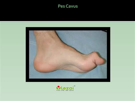 Pes Cavus: Causes, Symptoms, Daignosis, Prevention and Treatment by ...