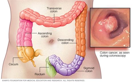 Colon cancer - Symptoms and causes - Mayo Clinic