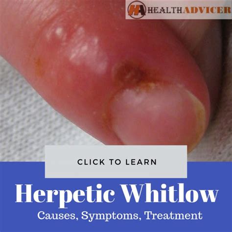 Herpetic Whitlow: Causes, Picture, Symptoms, Treatment