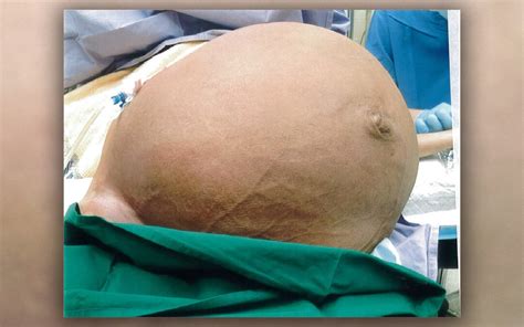 Pumpkin-Size 'Giant' Fibroid Removed from Woman's Uterus | Live Science