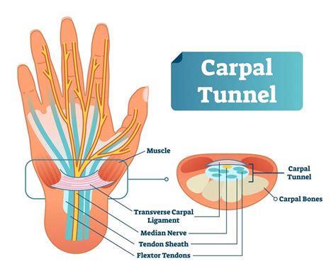 Carpal Tunnel Syndrome: What is it? | Lifemark