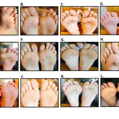 Graph representing the severity of symptoms on the patient's feet over ...