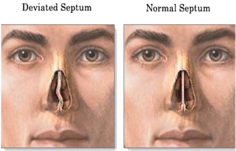 deviated septum nose job price - Quite A State Binnacle Image Library